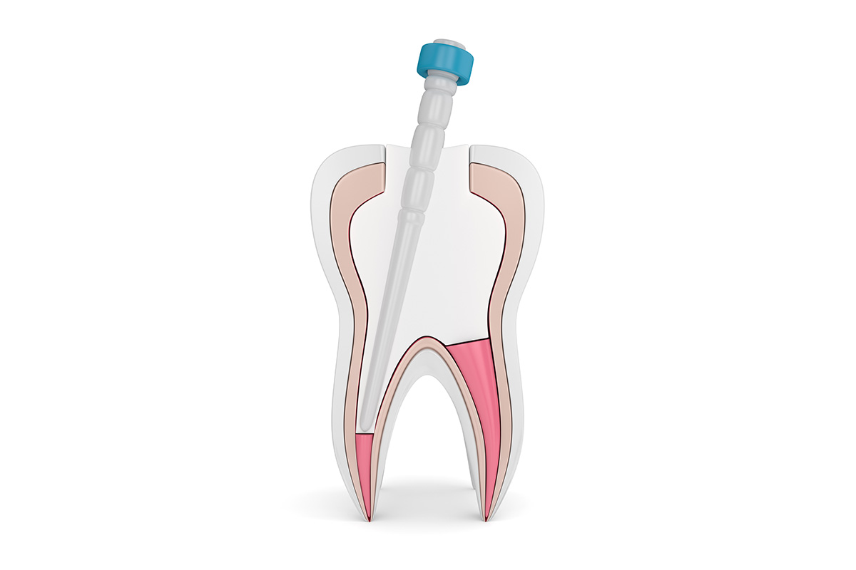 https://dentistkorkutgursoy.com/de/wp-content/uploads/sites/5/2021/03/kanal-tedavisi.jpg