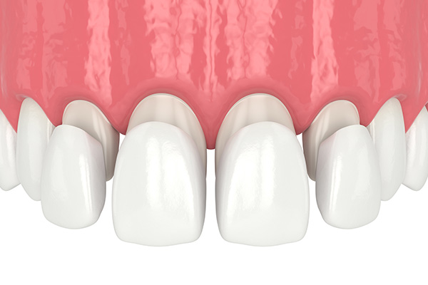 https://dentistkorkutgursoy.com/de/wp-content/uploads/sites/5/2021/03/lamina2.jpg