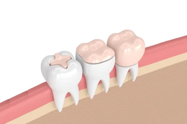 https://dentistkorkutgursoy.com/no/wp-content/uploads/sites/4/2021/03/inley-onley-dolgular.jpg