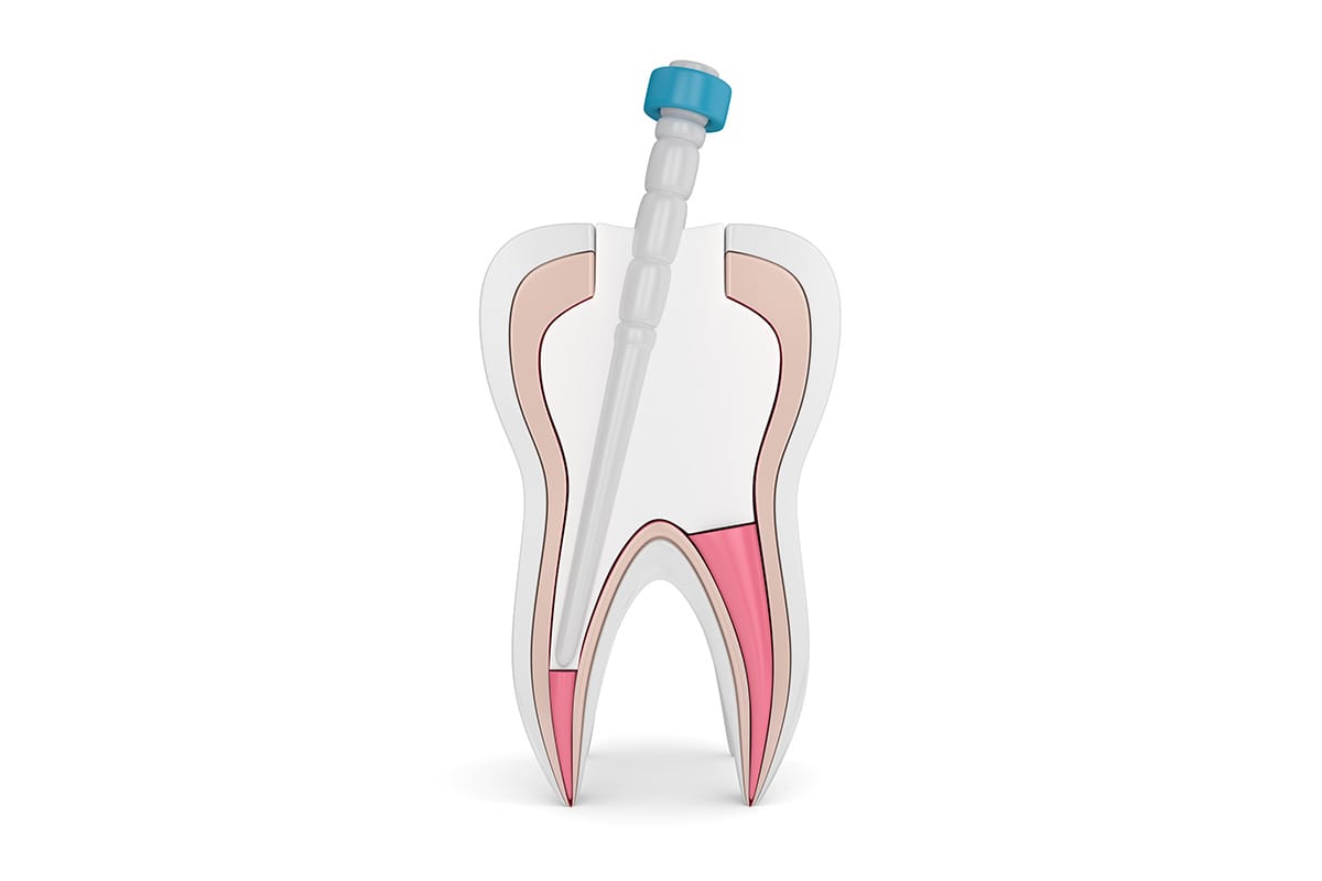 https://dentistkorkutgursoy.com/no/wp-content/uploads/sites/4/2021/03/kanal-tedavisi.jpg