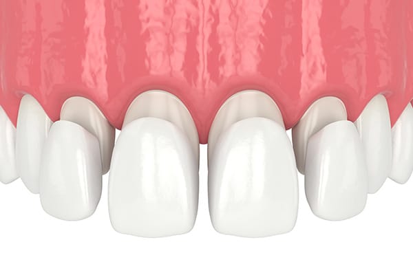 https://dentistkorkutgursoy.com/no/wp-content/uploads/sites/4/2021/03/lamina2.jpg