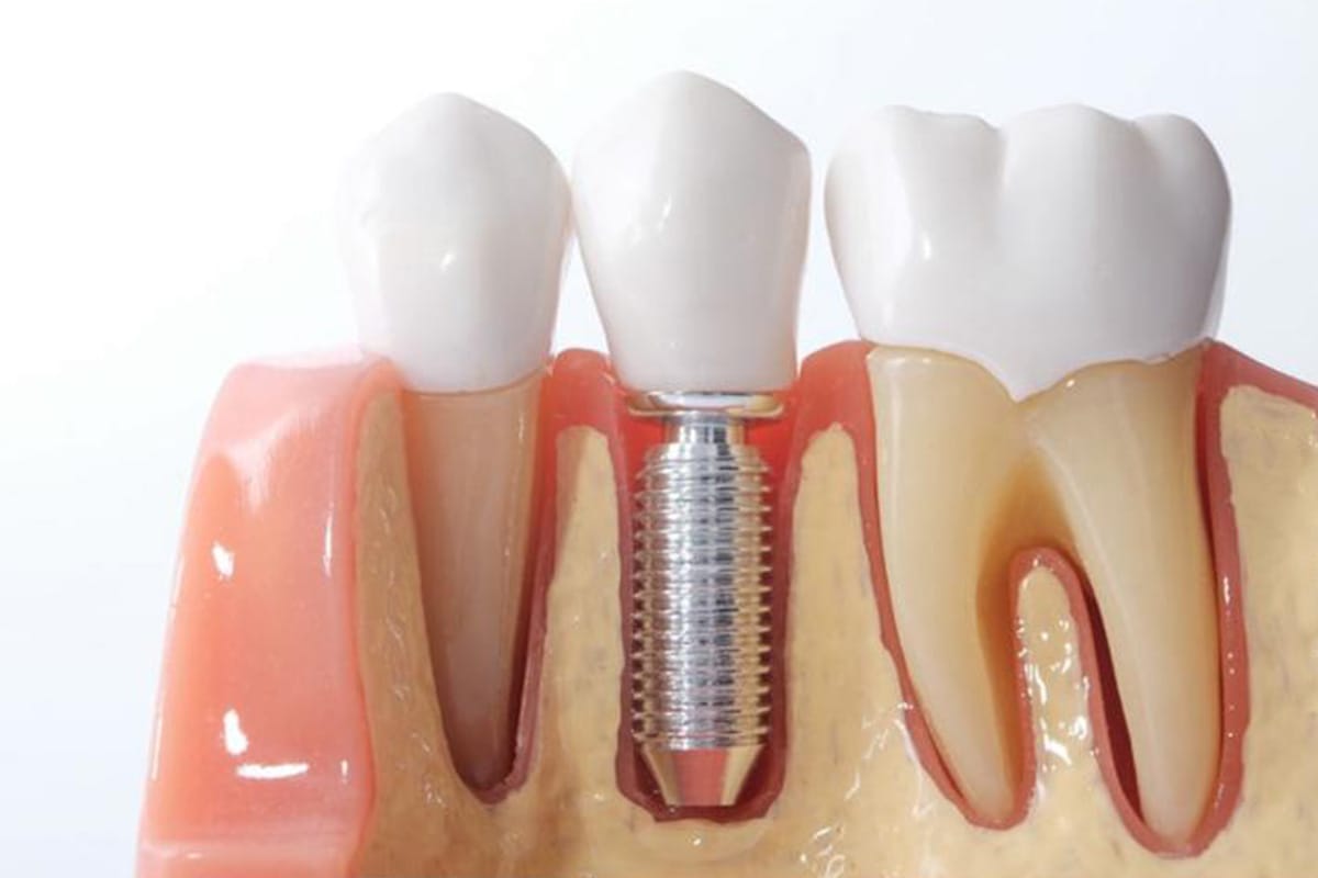 https://dentistkorkutgursoy.com/tr/wp-content/uploads/sites/7/2021/03/allon4.jpg