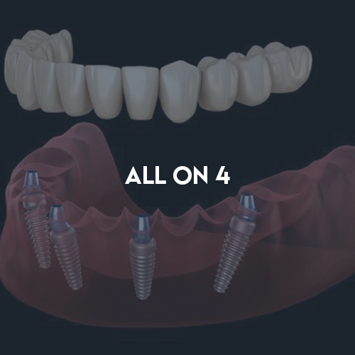 All On 4 Implant Treatment