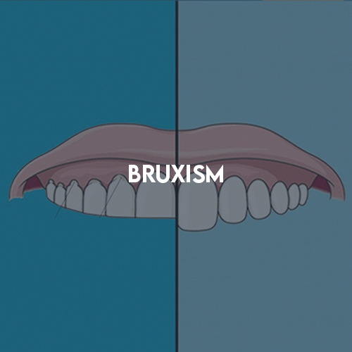 Bruxism
